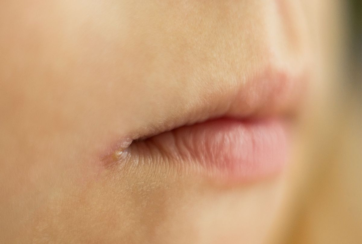 Angular Cheilitis